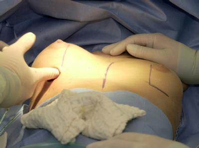 Bei einer Brustvergrößerung wird ein Silikon-Implantat eingesetzt Foto: Ulrich Perrey/ Archiv Brustvergrößerung