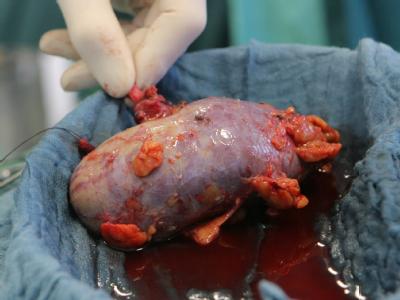 Am Universitätsklinikum Jena wird einem Spender eine Niere entnommen. Foto: Jan-Peter Kasper Nierentransplantation