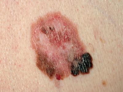 Jeder gesetzlich Krankenversicherte ab 35 Jahren hat alle zwei Jahre Anspruch auf eine kostenlose Hautkrebs-Vorsorgeuntersuchung. Foto: Universitäts-Hautklinik Tübingen Hautkrebs