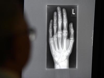 Ein Röntgenbild mit der linken Hand eines jungen Menschen im Alter zwischen 16 und 19 Jahren. Über die radiologische Untersuchung des Handwurzelknochens und der Hand lässt sich das Alter eines Menschen bestimmen. Foto: Felix Kästle Röntgenbild