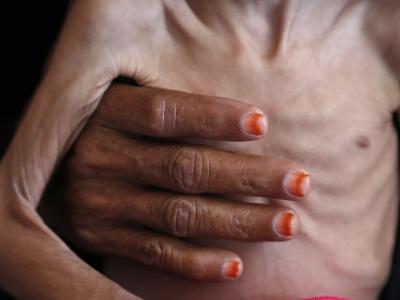 Eine Frau hält ein unterernährtes Kind in einem Krankenhaus in der Provinz Hadscha im Jemen. Humanitäre Krise im Jemen